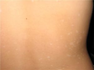 Появились белые пятна на теле