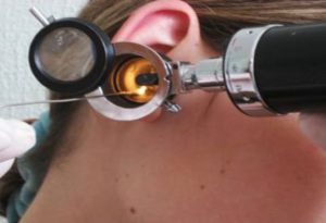 Прокол барабанной перепонки-правильно назначено лечение, чтобы избежать дальнейших последствий?