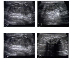 Новообразование в груди с акустической тенью