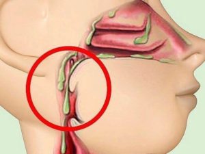 Зелёная неприятная на вкус слизь стекает по задней стенке горла