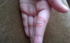 Образование на сгибе пальца под кожей, болит при нажатии