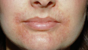 Красные пятна вокруг рта