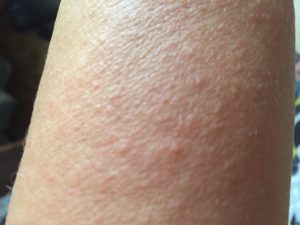 Сильный зуд по всему телу