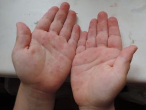 Высыпания на ступнях и ладонях, нёбе