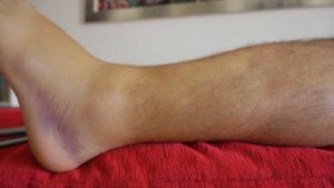 Травма голени не проходит отек