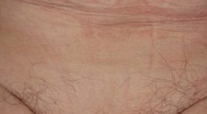 Перестали расти волосы посередине лобка