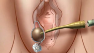 Припухлость возле входа во влагалище