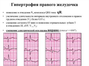 Смещение ST вниз (V5) / Отклонение параметров qrs (avr)