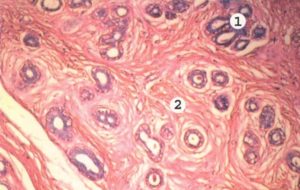 Фиброзные тяжистости