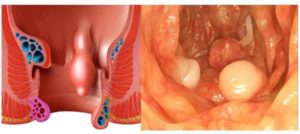 Нащупала что-то в прямой кишке