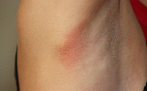 Зуд подмышками и в паху