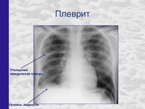 Утолщение плевры