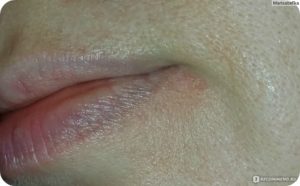 Шелушится кожа в уголках рта