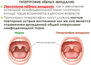 Могут ли вырасти новые миндалины