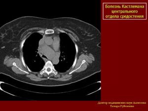 Болезнь Кастлемана