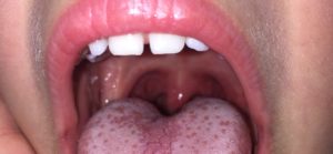 Красный прыщ на миндалине