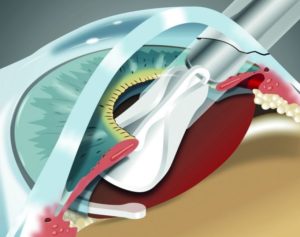 Повторная замена хрусталика
