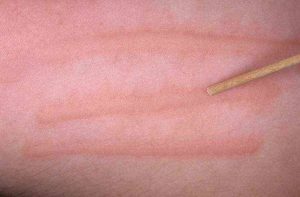 Кожа краснеет после механического прикосновения