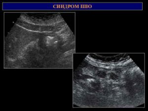Симптом поражения полого органа
