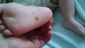 Жёлтое пятно на стопе