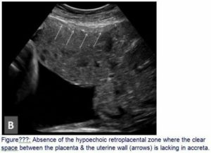 Плацента на передней стенке. Расширение МВП. Анэхогенная структура