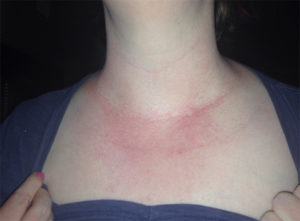 Аллергия на мильгамму