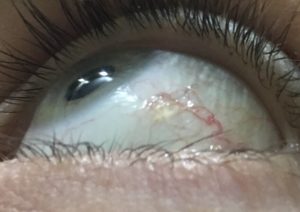 Желеобразное образование на белке глаза