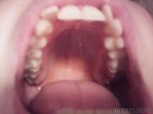 Белое пятнышко у ребенка на нёбе