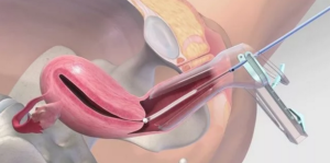 Биопсия эндометрия и беременность