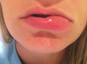 Опухла половя губа что делать?