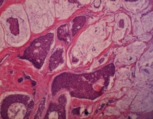 Карцинома G2