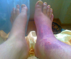Волдыри, пузыри под гипсом, отек, синюшность