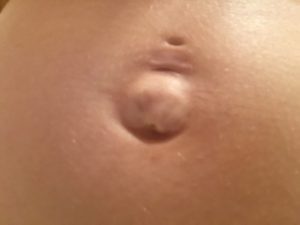 Вылез пупок во время беременности