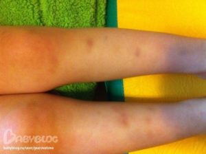 Стали появляться синяки на ногах у ребёнка в 8 лет