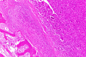 Карцинома G2