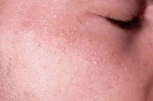 Болючие внутренние прыщи и закрытые комедоны на лице