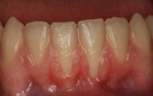 Температура, воспаление дёсен, слабость