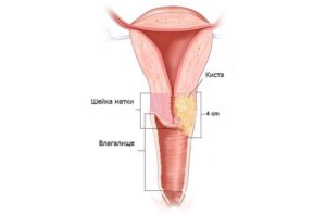Твердый шарик на шейке маткт