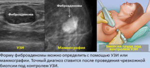 Рак или фиброаденома