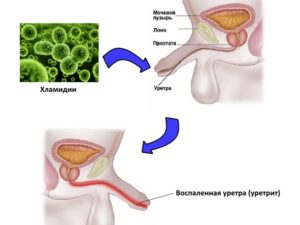 Ожог уретры