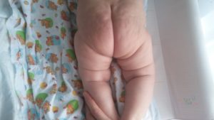 Появились несимметричные складочки в 7 месяцев