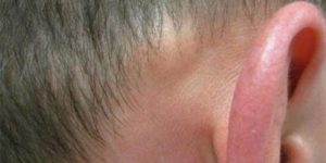 Обнаружила шишку твердую за ухом