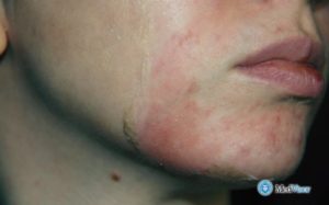 Ожог лица салициловой кислотой