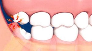 Шишка у зуба мудрости