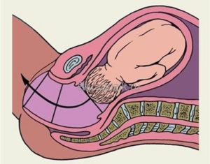 Роды 41-42 недели, шейка матки не готова