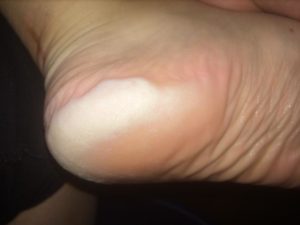 Кожа на ногах от воды белеет