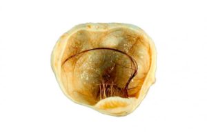 Дермоидная киста