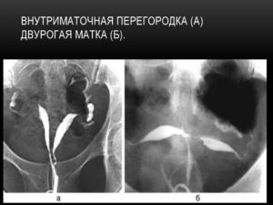 Перегородка в матке