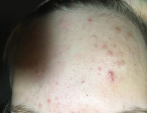 Акне 3 степени