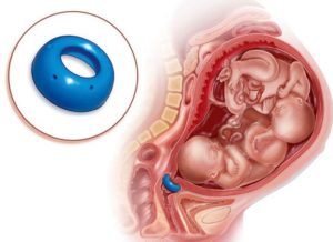 Снятие пессария